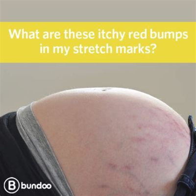 Why Does My Stretch Marks Itch: The Mysterious Connection Between Skin and Memory